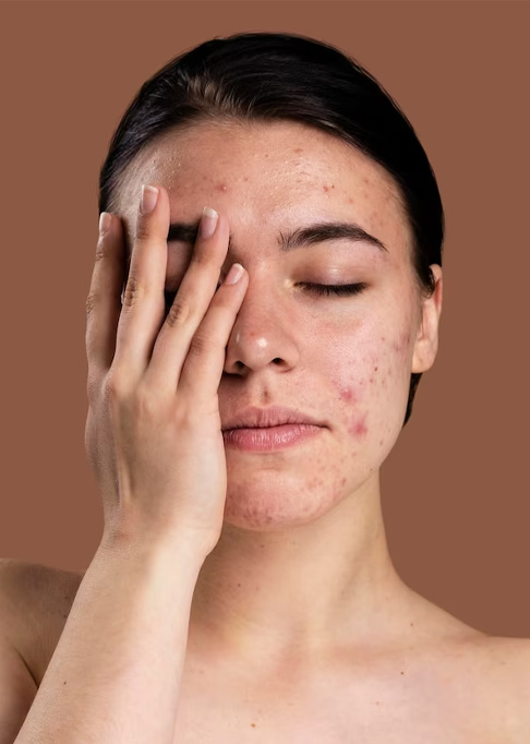 Scopri come trattare l'acne ormonale negli adulti